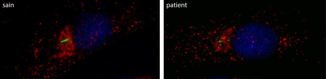 Le cil primaire (en vert) est très court dans les cellules de la peau de patients portant une mutation dans le gène VPS15 et atteints de ciliopathie, comparé aux cellules d’individus sains. Le noyau est marqué en bleu et la protéine VPS15 est en rouge.