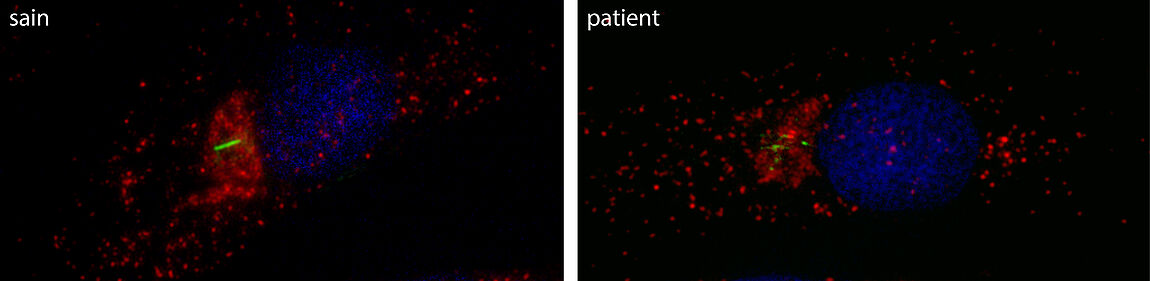 Le cil primaire (en vert) est très court dans les cellules de la peau de patients portant une mutation dans le gène VPS15 et atteints de ciliopathie, comparé aux cellules d’individus sains. Le noyau est marqué en bleu et la protéine VPS15 est en rouge.